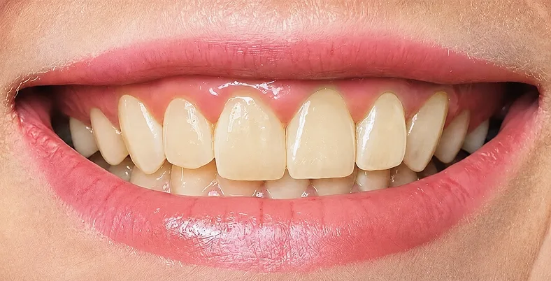 Teeth before whitening, yellow shade
